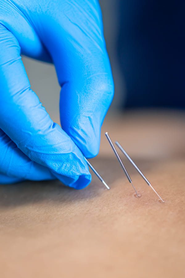 Un primer plano de una aguja y las manos del fisioterapeuta haciendo una aguja seca
